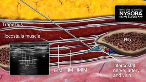 intercostal nerve blocks treatment.